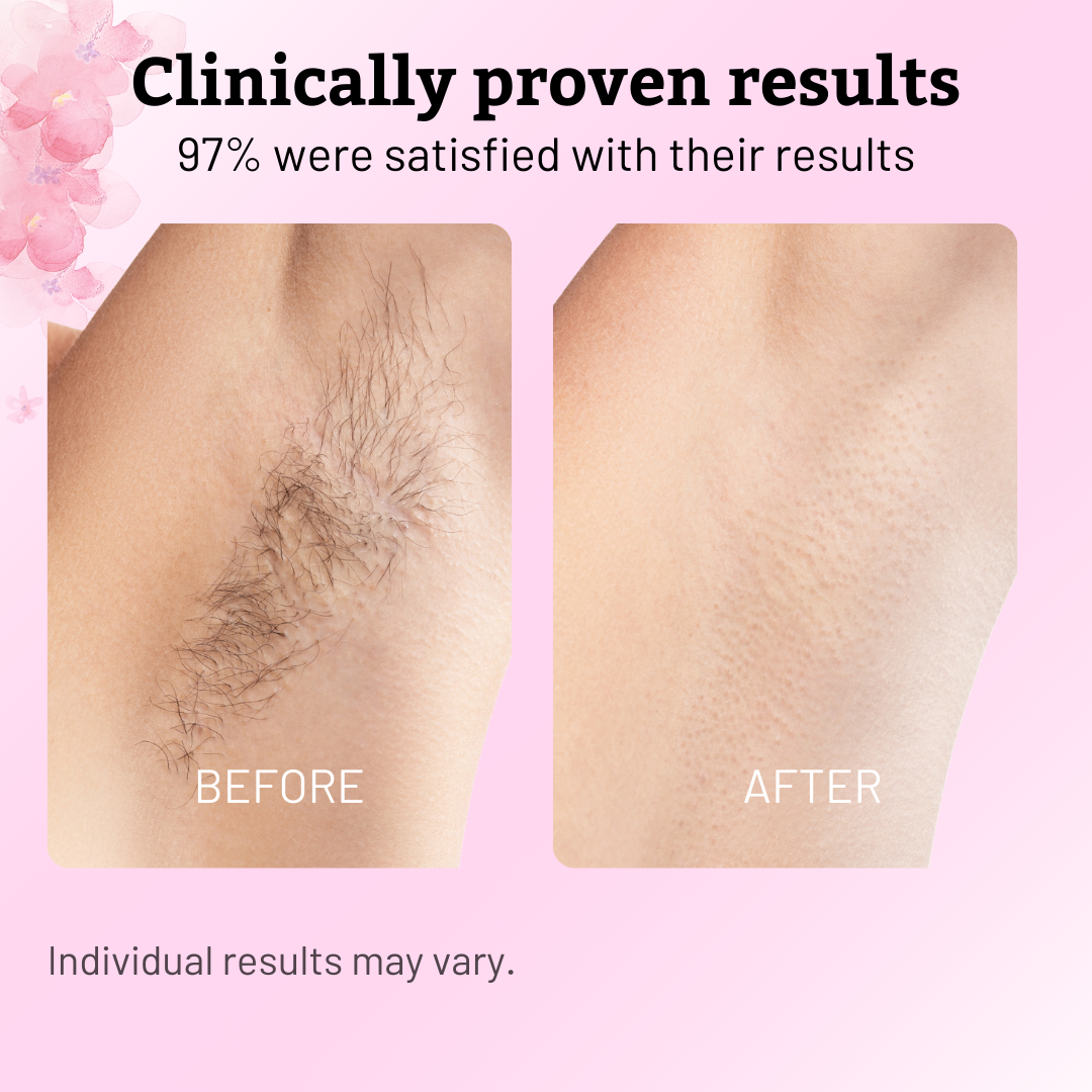 Cyperus Rotundus Oil for Hair Reduction